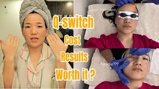 Considering Q-Switch Laser in Delhi? My Honest Review Saves You Time & Money
