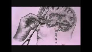 El procedimiento m&eacute;dico m&aacute;s retorcido de la historia: la lobotom&iacute;a
