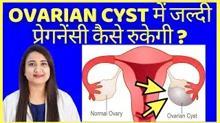 OVARIAN CYST में जल्दी प्रेगनेंसी कैसे रुकेगी ? OVARIAN CYST TYPES, CAUSES, SYMPTOMS AND TREATMENT