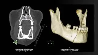 Recognizing Facial Fractures on CT Scans