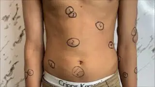 Lipoma Removal Live Before Surgery: Patient Examination and History Review #lipoma #lipomatreatment