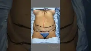 Lower Body Lift, Tummy Tuck Revision, & Buttock Lipoaugmentation ⏳