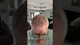 Hair Growth Results in 1 Year | Dr.Cinik Hair Transplant | Before After