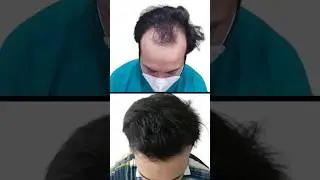 Hair Transplant in India : Divine Hair Transplant Result #shortsfeed