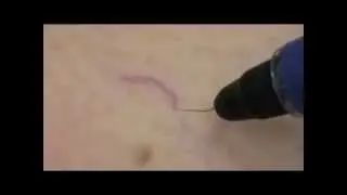 Spider veins being treated by VeinGogh's Ohmic Thermolysis System