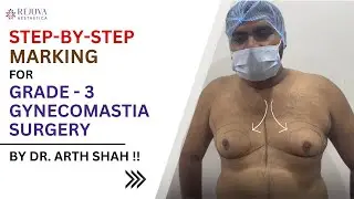 Dr. Arth Shah explains Step-by-Step Marking for Grade 3 Gynecomastia Surgery. Learn the Technique!