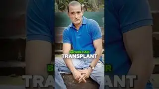 How AI Reveals Your Hair Transplant Results Before Surgery - Know Your Perfect Hairline Shape NOW!
