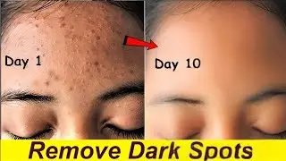 How to Remove Dark Spots from Face Naturally at Home ✨ 