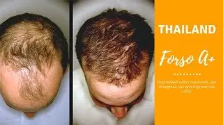 Stop hair loss after 12 days - Forso A +