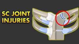Sternoclavicular Joint Injury: Clinical Features, Classification, Treatment and Complications