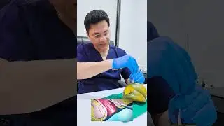 Effective Treatment for Transsphincteric Fistula: Step-by-Step Fixcision Procedure explained