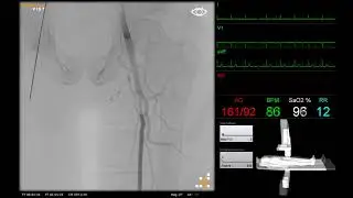 Peripheral Angiography