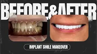 Final 3-on-6 Implant Smile Makeover | Full Arch Dental Implants in Chicago