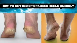How to Heal Cracked Heels Fast with Home Remedies | Cracked Heel Treatment