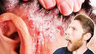 Allergic Reactions to Hair System Adhesive