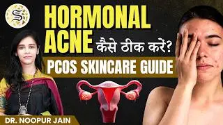 How to treat PCOS acne 🔥 | PCOS Pimples on Chin & Jawline | Acne Treatment That Actually Works