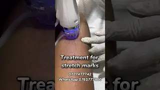 Treatment for Stretch marks #skincenter #skincare #skintreatment #stretchmarks #skincaresrilanka