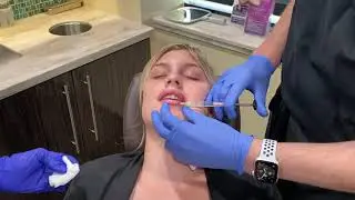 Restylane Kysse FDA Approved for Lip Injections