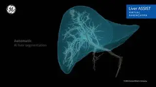 Introduction to GE Healthcare Liver ASSIST Virtual Parenchyma