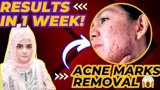 Fade Acne Marks Fast with 2 Natural Remedies | Acne Marks Removal At Home | SEE RESULTS IN 1 WEEK!