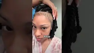I grew my edges back using Minoxidil 5%  #minoxidil #hairloss #beforeandafter #hairgrowth #alopecia