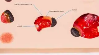 'Pat' Pressure Ulcer Staging Model&trade;