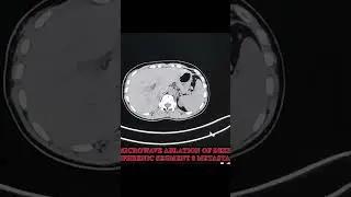 #SHORTS#MICROWAVE ABLATION OF DEEP SUBPHRENIC SEGMENT &METASTASIS#IR FACILITIES TREATMENT