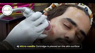 Acne Scar Treatment Micro-needling Radiofrequency(RF) #acnescartreatment #mnrf #skintreatment #skin