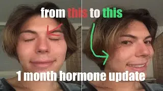 low dose estrogen hrt 1 month update (bicalutamide and estradiol)