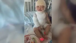 Akron mother speaks after 1-year-old daughter severely burned under babysitter's watch