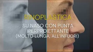 Caso di rinoplastica su naso con punta iperproiettante