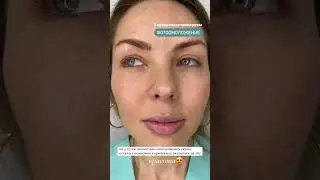 5 день после процедуры фотоомоложение. 🤩 Полное восстановление после фотоомоложения. Косметология