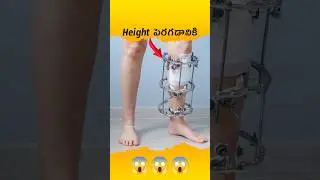 😬😬😬 Limb lengthning Process | Height increase surgery