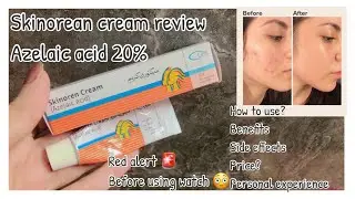 Skinoren cream review |Skinoren uses and side effects |Azelaic acid 20%|get rid of acne