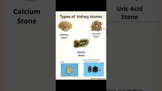 #Kidney Stones #Homoeopathic Remedies