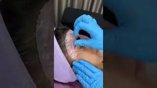 Hairy forehead gets clean by wax #forehead #wax #waxingvideos #waxingstorytime