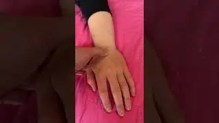 Palpation: Scaphoid