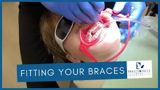 How are Braces Put On - 14 years old patient