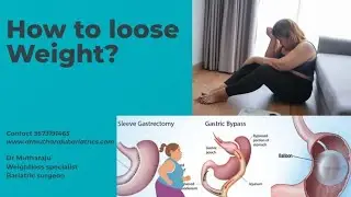 How to loose weight? Diet, Bariatric surgery Best bariatric surgeon 