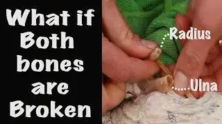 How to repair broken Wing? Ulna and Radius.