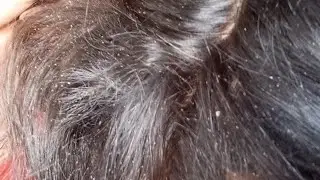 #LiceRemoval #HeadLiceTreatment #HomeRemedies #HealthyHair #LiceFree