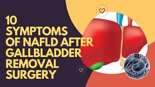 10 Symptoms Of Non-Alcoholic Fatty Liver Disease After Gallbladder Removal Surgery