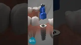 Diş İmplantı Nasıl Yapılır ? #dentaltourismturkey #hollywoodsmile #smiledesignturkey