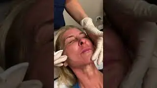 TCA Skin Peel by Dr. Alex Khadavi in office.