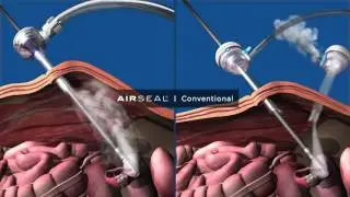 TBnRG SQ Airseal Smoke Evacuation