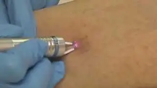 Laser Treatment of Spider Veins