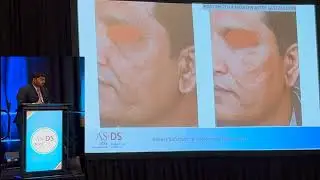Acne Scar Treatment -  Subcision & Fat Grafting - American Association of Dermatologic Surgery 2024