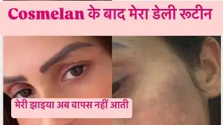 Cosmelan के बाद skincare कैसे करनी है मेरी झाइया क्यों नहीं आती #melasma #skincare #dailyroutine