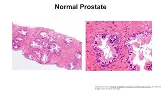 Understanding cell reprogramming in treatment-resistant prostate cancer using organoids