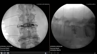 DIscogram and post disco CT